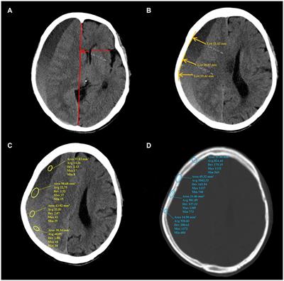 Predicting the progression of chronic subdural hematoma based on skull density
